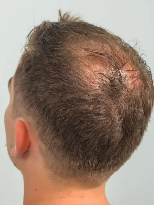 crown_hair_thinning_man