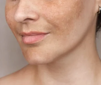 melasma-treatment