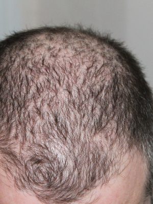 reduced_hair_density